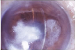 角膜炎後の混濁の例